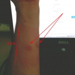 mosquito_tigre_picadura_1 mosquito_tigre_picadura