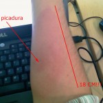 mosquito_tigre_picadura_2 mosquito_tigre_picadura_2