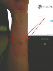 mosquito_tigre_picadura_1 mosquito_tigre_picadura