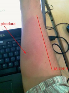 mosquito_tigre_picadura_2 mosquito_tigre_picadura_2